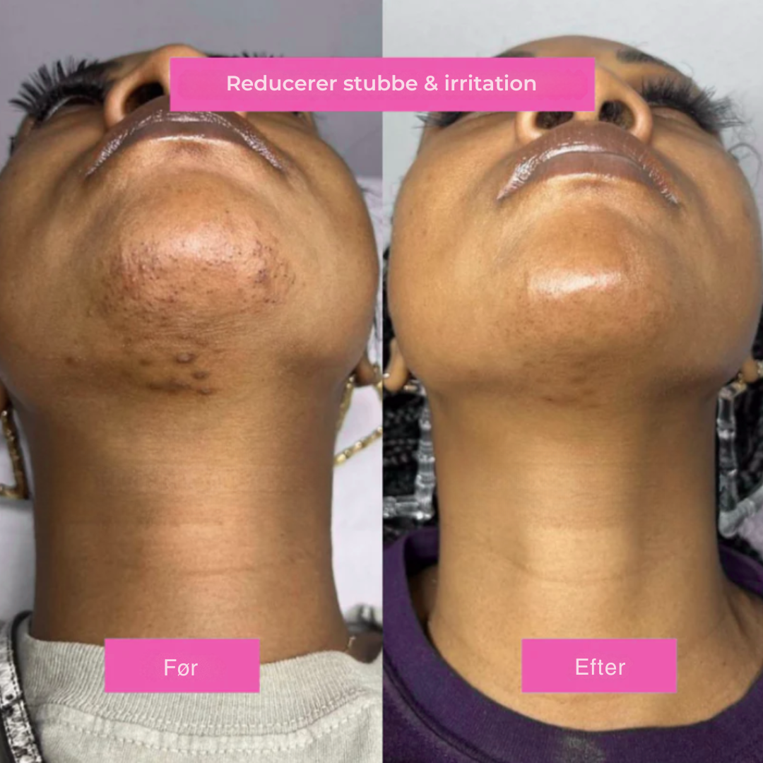 Hårfjerningsolie – Naturligt glat hud uden skraber